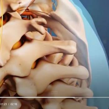Cervical Epidural Steroid Injection Video