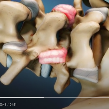 Cervical, Thoracic and Lumbar Facet Joint Injections