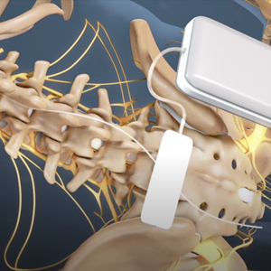 Spinal Cord Stimulation for Chronic Back Pain